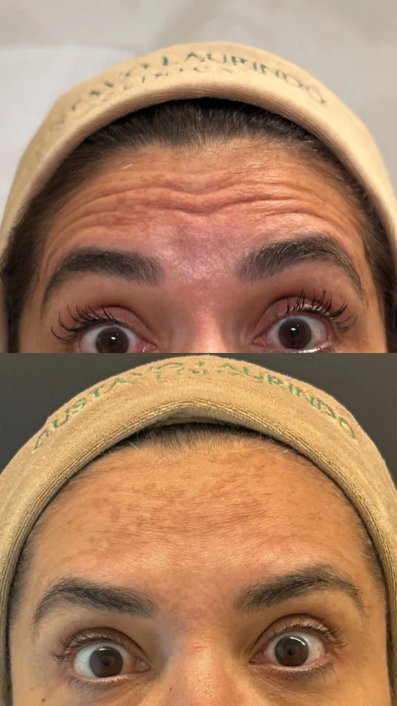 aplicacao-botox-em-brasilia-especialista