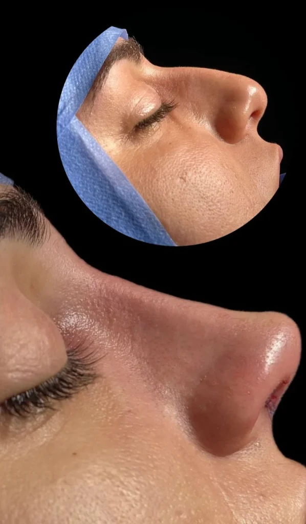 Clínica Gustavo Laurindo - rinoplastia Brasília